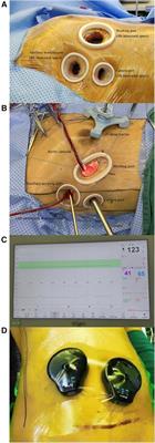 Frontiers Case Report Totally Endoscopic Minimally Invasive Mitral